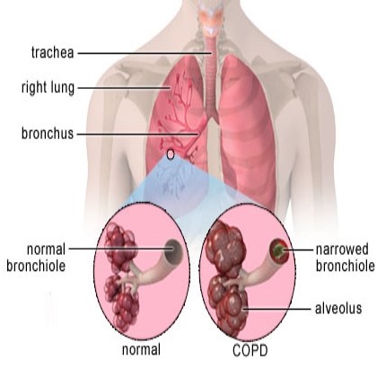 Normal and COPD Lungs